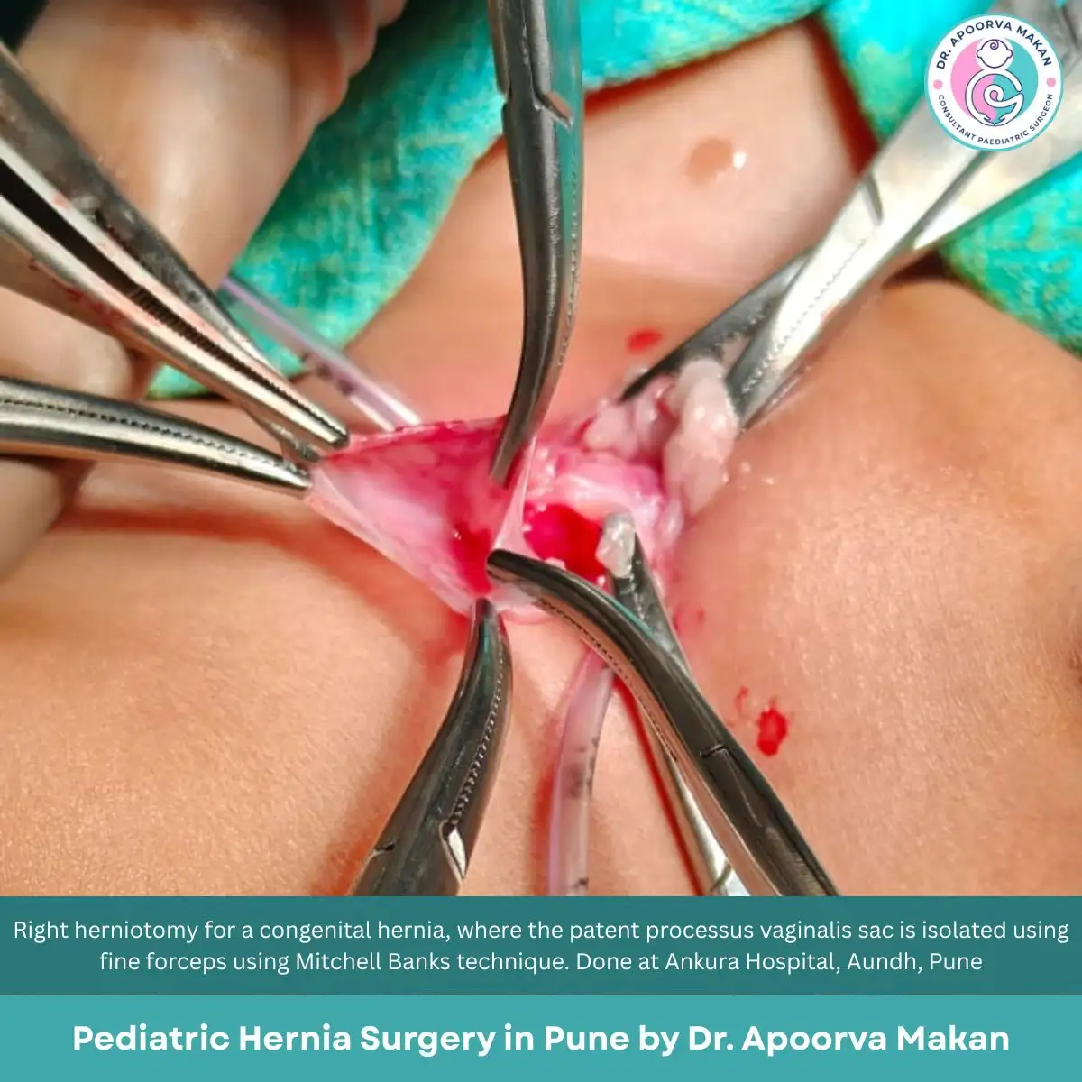 Hernia sac preparation in hernia surgery in Ankura Hospital, Aundh Pune