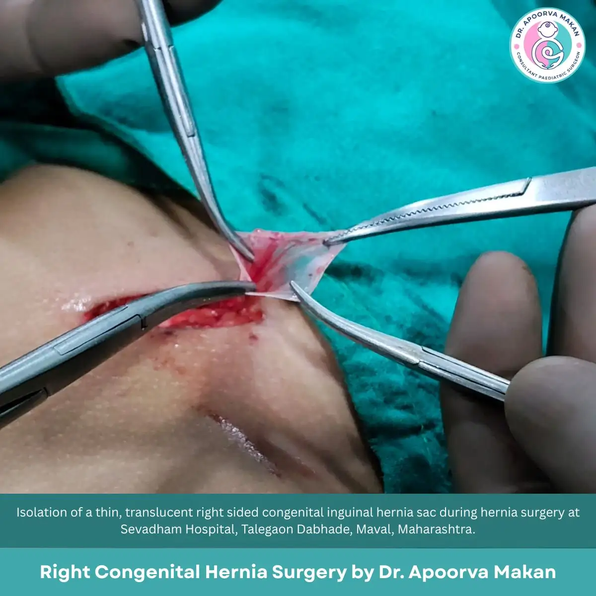 Surgical forks holding delicate hernia sac at Hernia surgery in Talegaon Dabhade
