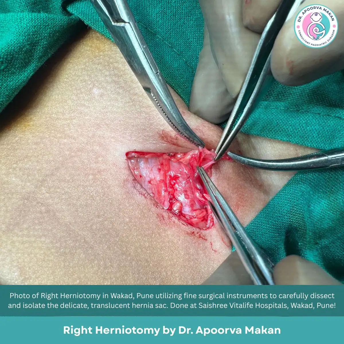 Pediatric Hernia repair surgery in progress Saishree Vitalife Hospitals in Wakad, Pune.