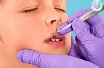 Stiches being applied on lips of boy.