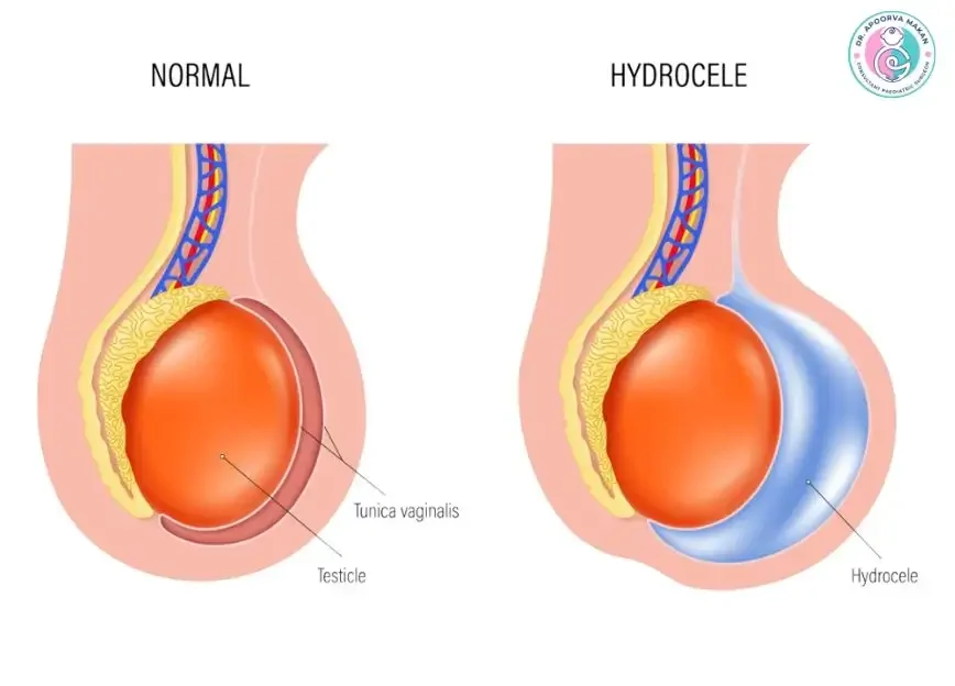 Illustration of Hydrocele vs Normal Scrotum Condition.